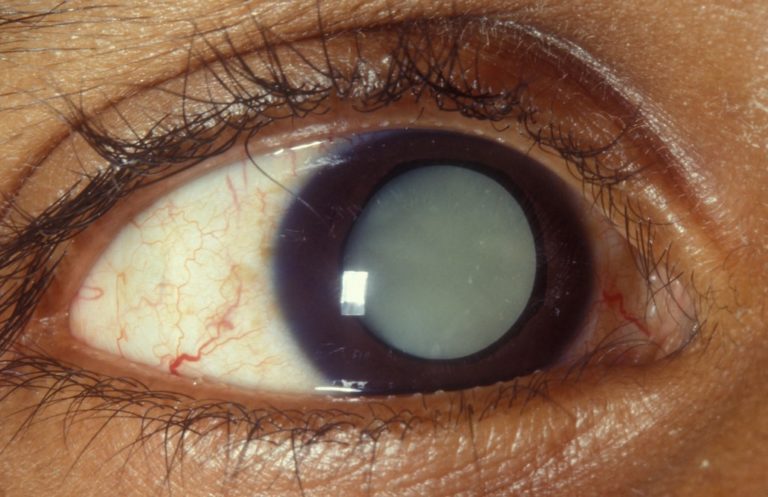 Cataract Surgery What Can One Expect Before During And After The Surgery Hudson Ophthalmology 
