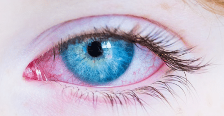 Pink Eye & Coronavirus | Hudson Ophthalmology