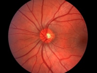 Diabetic Eye Care Services