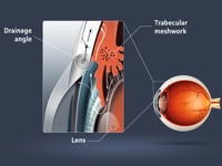 Laser Glaucoma Surgery